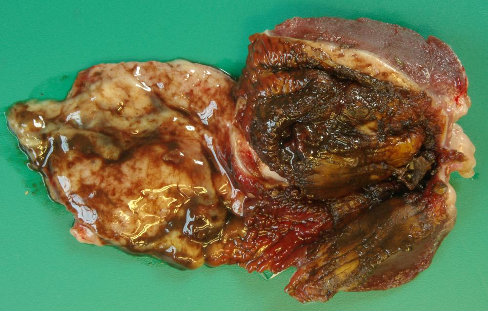 Duck proventriculus and gizzard, with haemorrhagic contents and swollen, inflamed mucosa