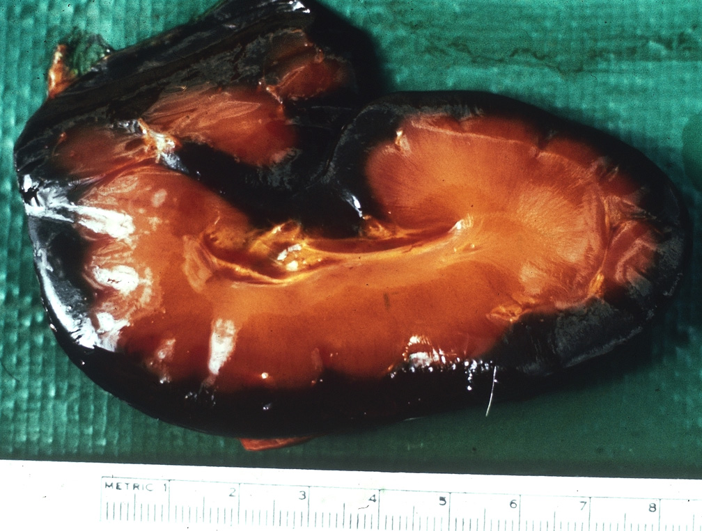 Horse kidney with dark red cortex due to haemoglobinaemia. The medulla and pelvis display icterus.